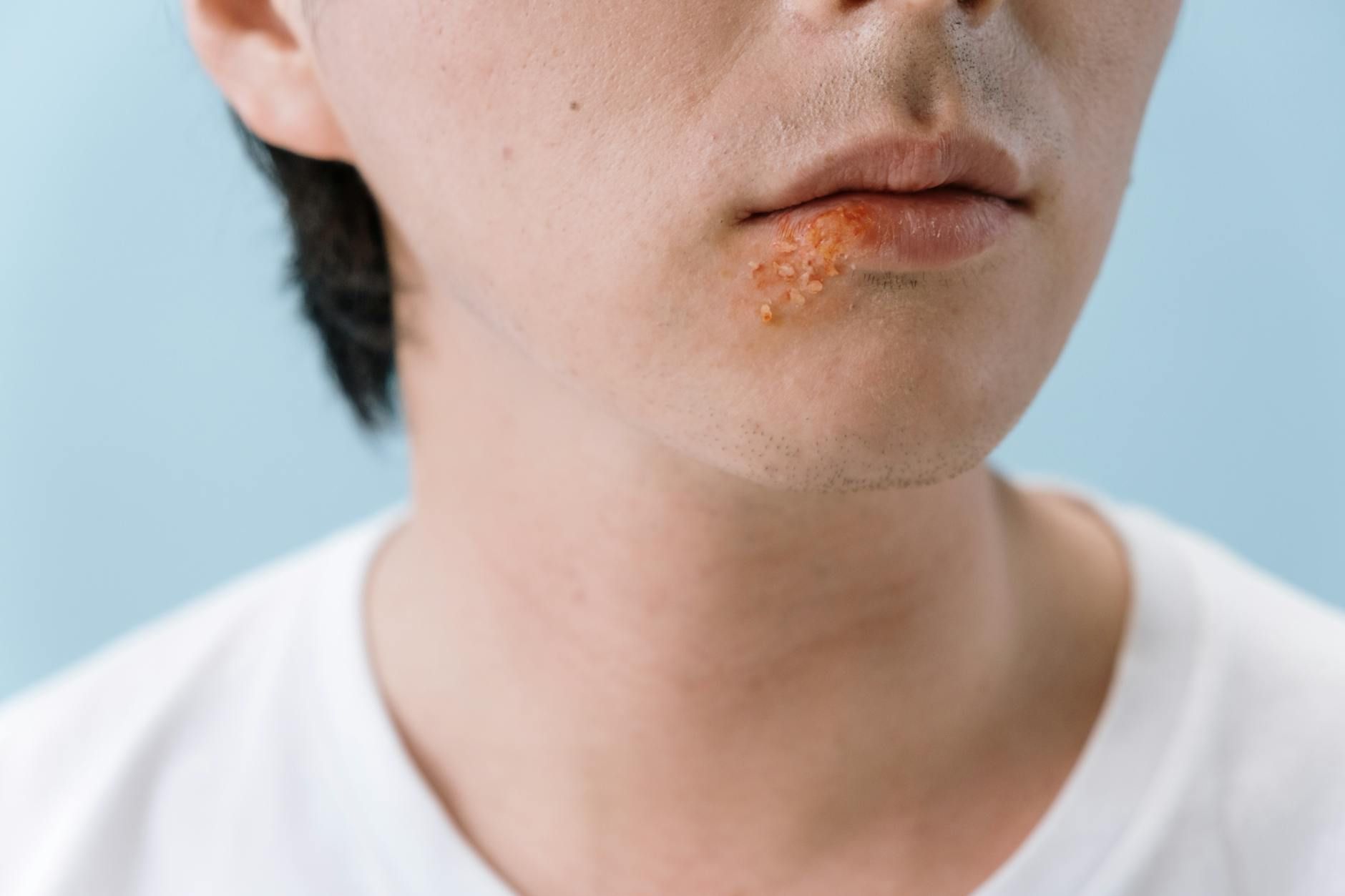 You Won't Believe What Happens When You Kiss Someone with Herpes!